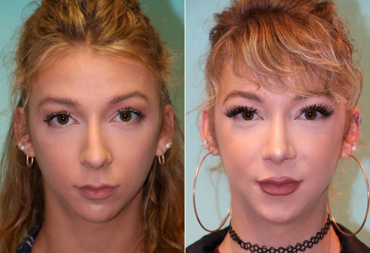 Before and after Rhinoplasty by Dr. Shervin Naderi, Patient 14039