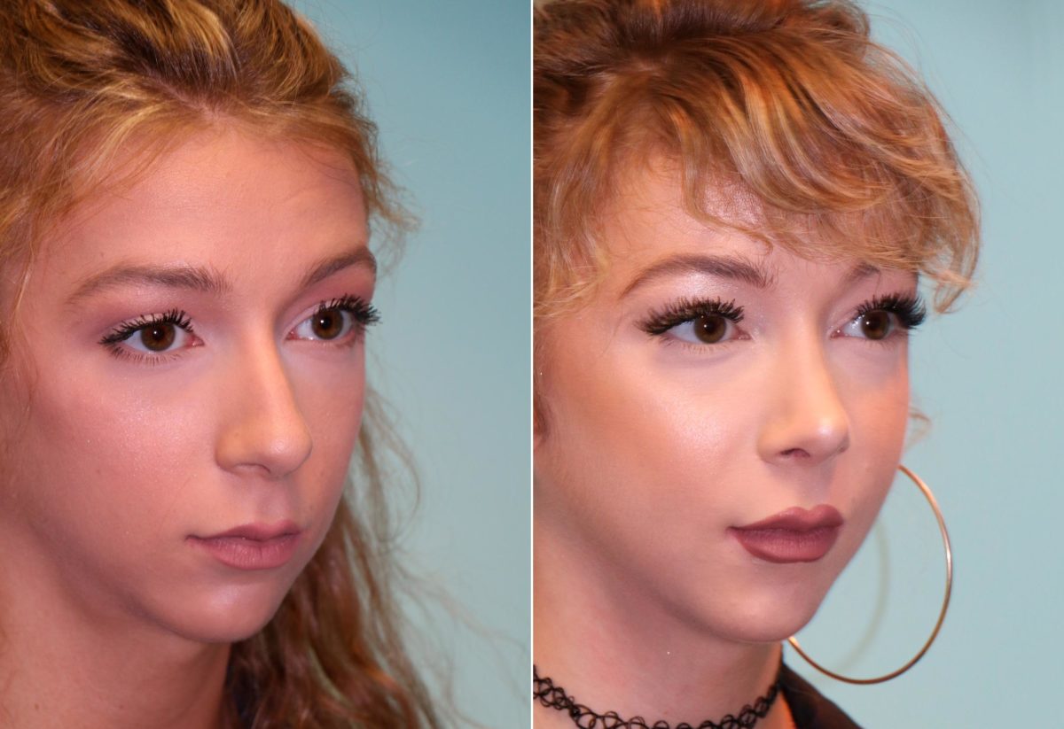 Before and after Rhinoplasty by Dr. Shervin Naderi, Patient 14039