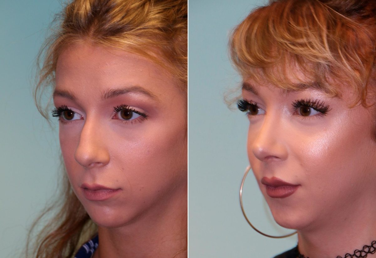 Before and after Rhinoplasty by Dr. Shervin Naderi, Patient 14039