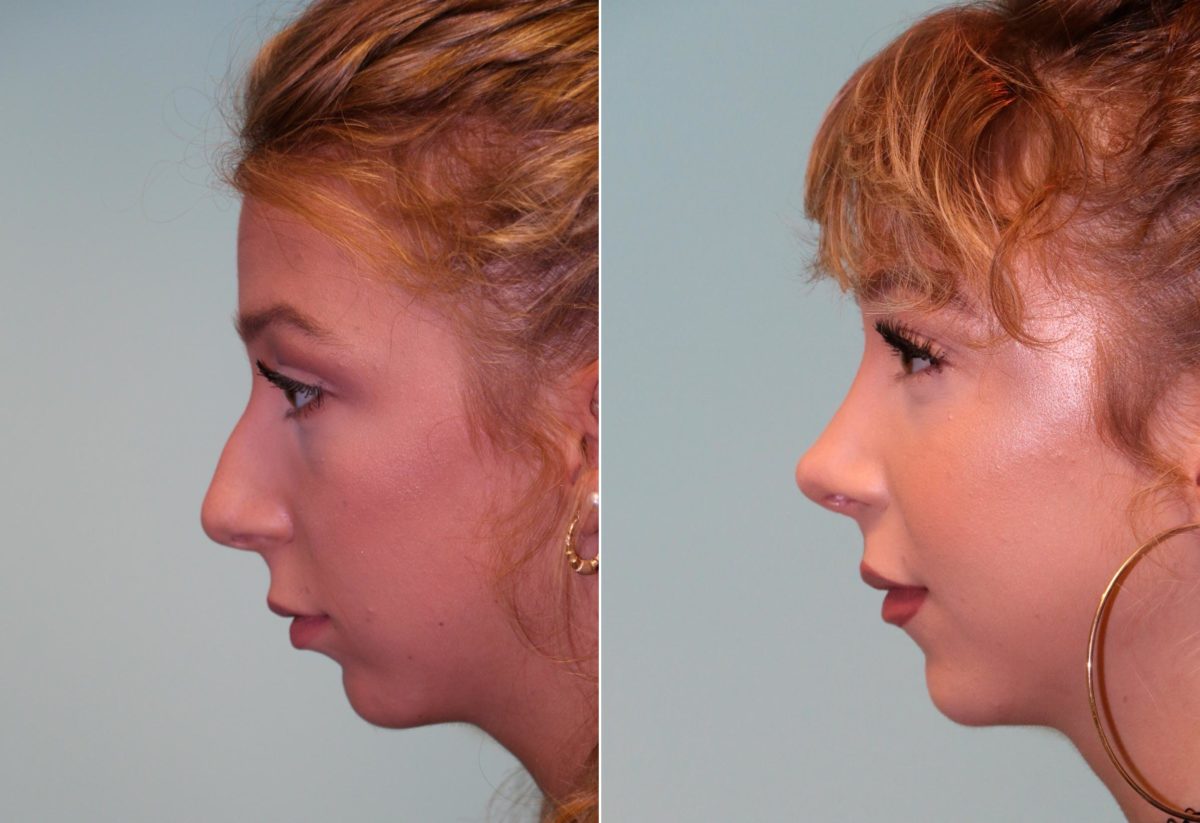 Before and after Rhinoplasty by Dr. Shervin Naderi, Patient 14039