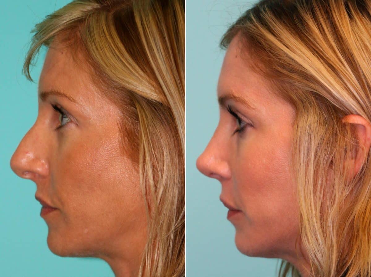 Before and after Rhinoplasty by Dr. Shervin Naderi, Patient 13917