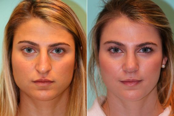 Before and after Rhinoplasty by Dr. Shervin Naderi, Patient 14015