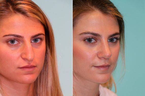 Before and after Rhinoplasty by Dr. Shervin Naderi, Patient 14015