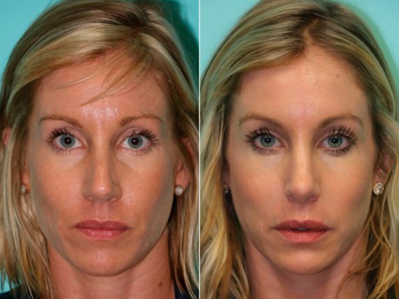 Before and after Rhinoplasty by Dr. Shervin Naderi, Patient 13917