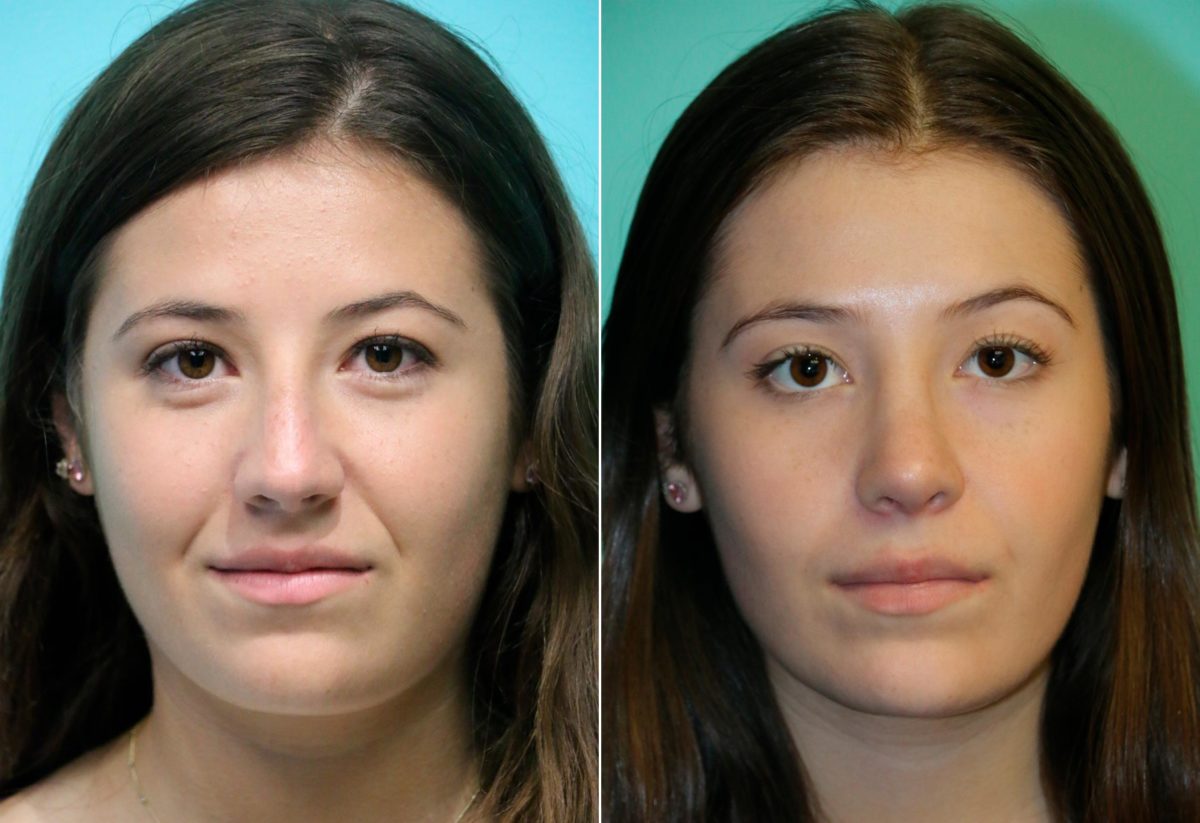 Before and after Rhinoplasty by Dr. Shervin Naderi, Patient 14029