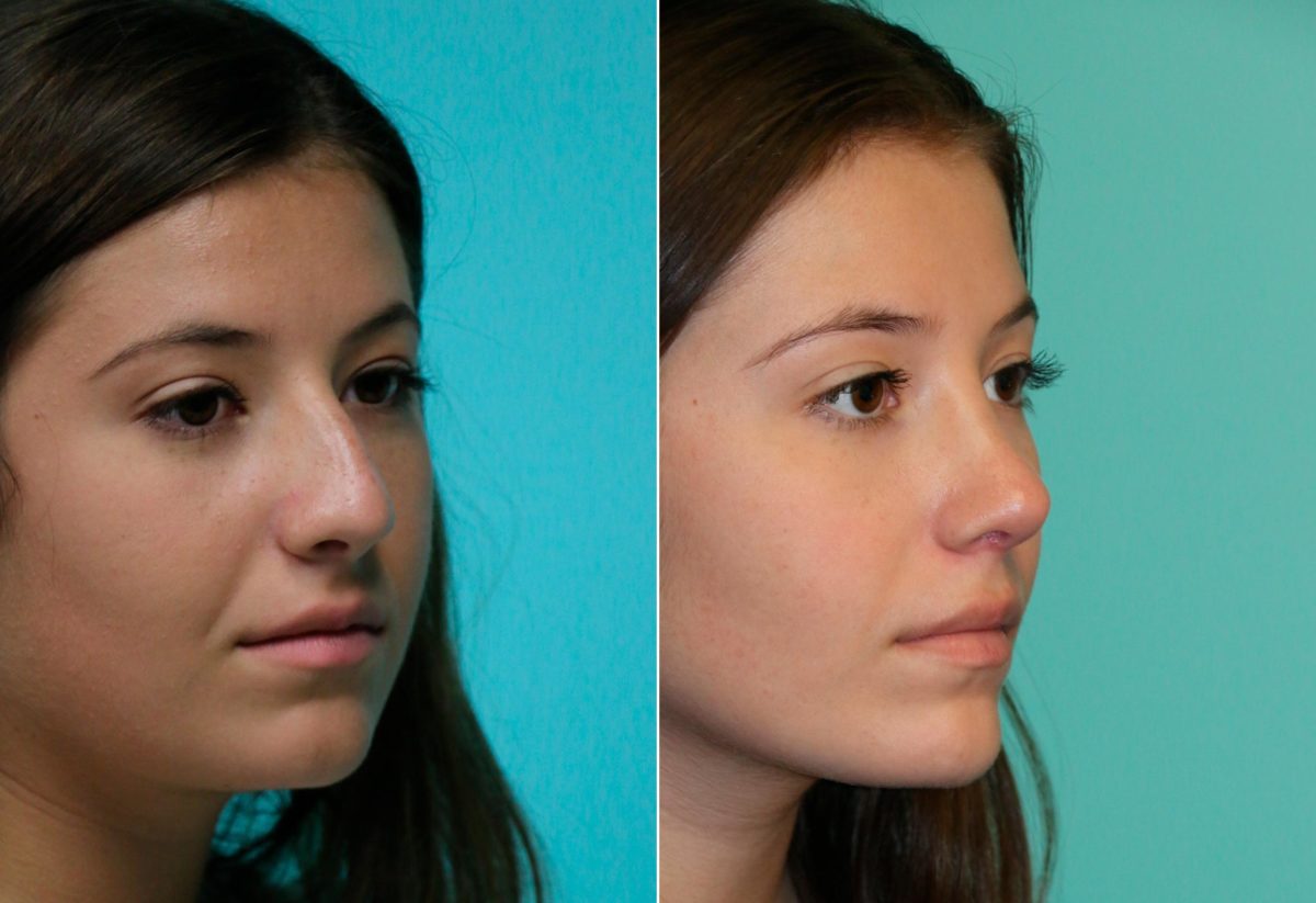 Before and after Rhinoplasty by Dr. Shervin Naderi, Patient 14029