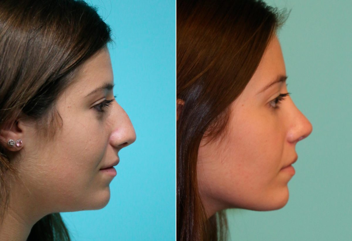 Before and after Rhinoplasty by Dr. Shervin Naderi, Patient 14029