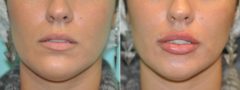 Before and after Injections by Dr. Shervin Naderi, Patient 14096