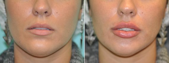 Lip Injections before and after photos in Chevy Chase, MDLip Injections Before and After Photos in Chevy Chase, MD