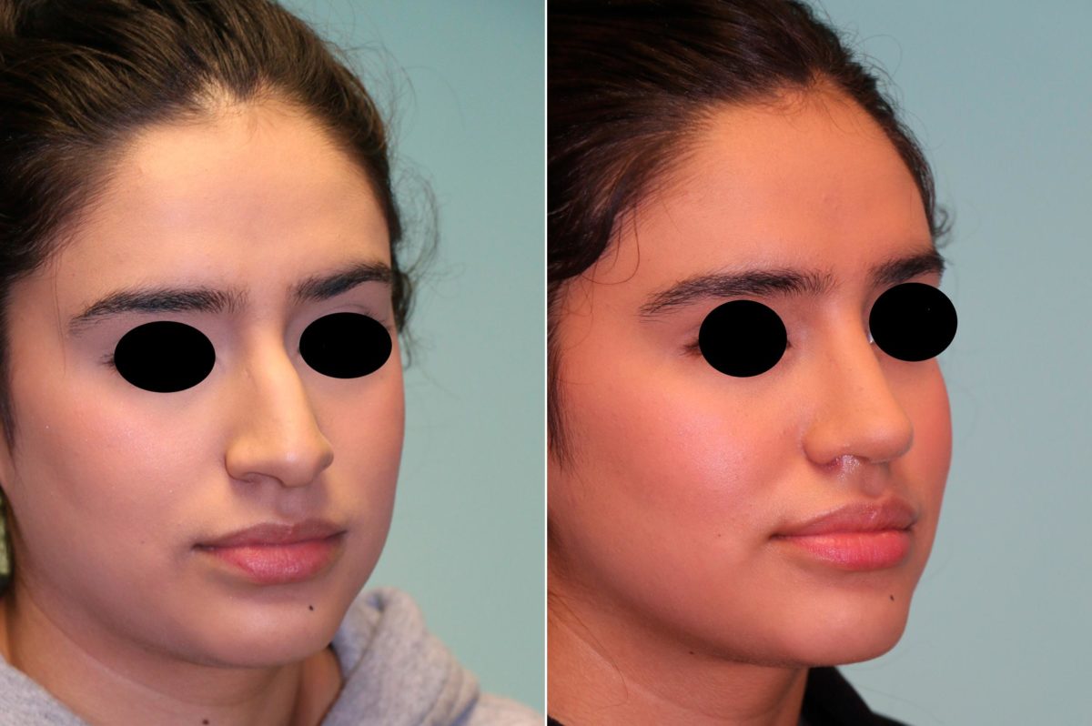 Before and after Rhinoplasty by Dr. Shervin Naderi, Patient 14057