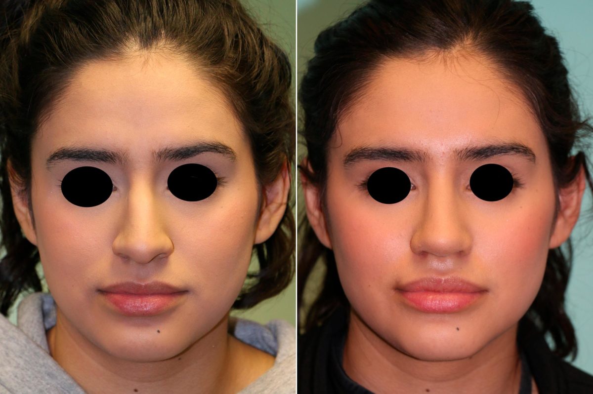 Before and after Rhinoplasty by Dr. Shervin Naderi, Patient 14057