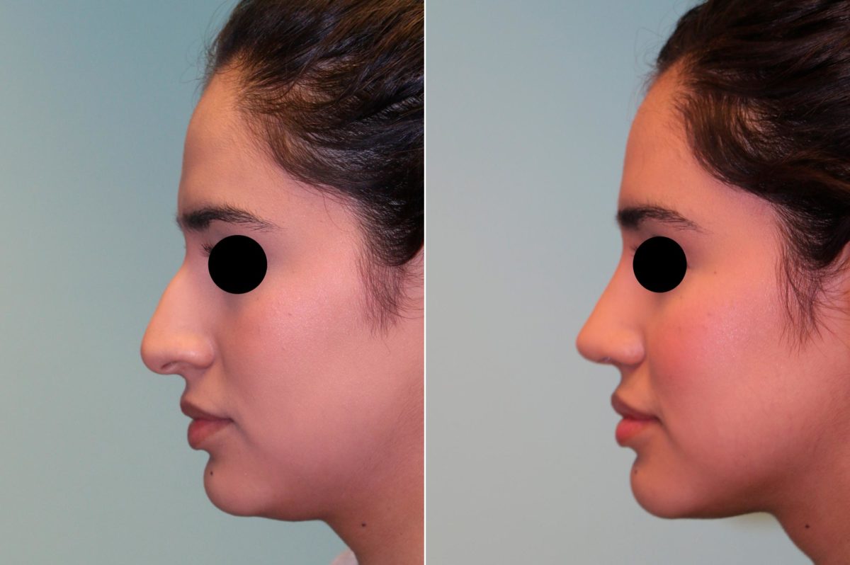 Before and after Rhinoplasty by Dr. Shervin Naderi, Patient 14057