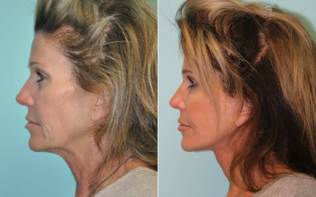 Before and after Facelift by Dr. Shervin Naderi, Patient 14162