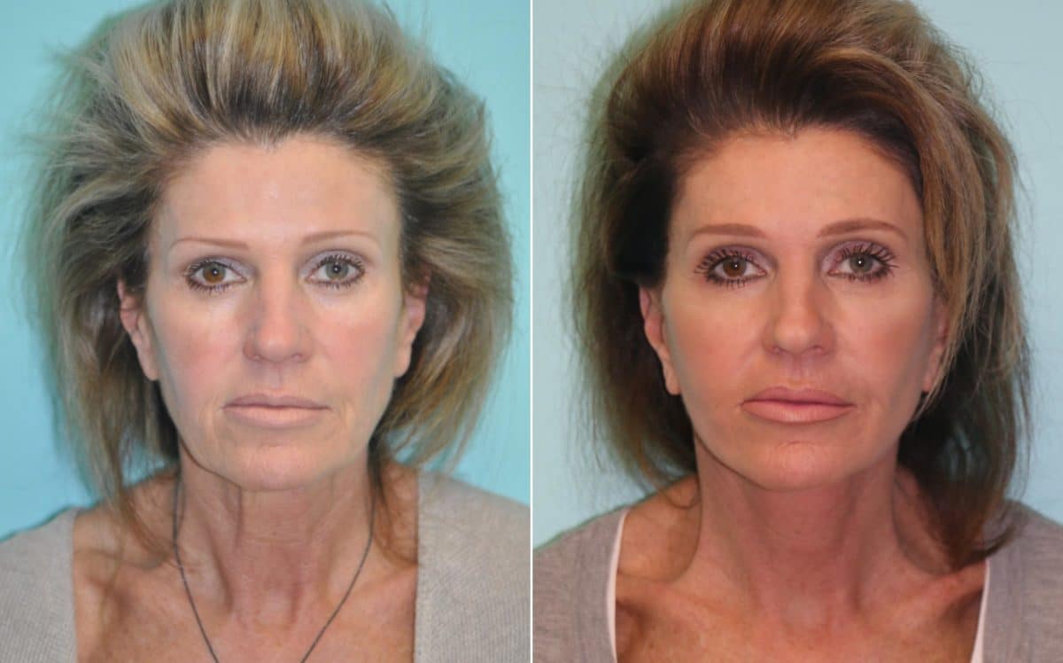 Before and after Facelift by Dr. Shervin Naderi, Patient 14162