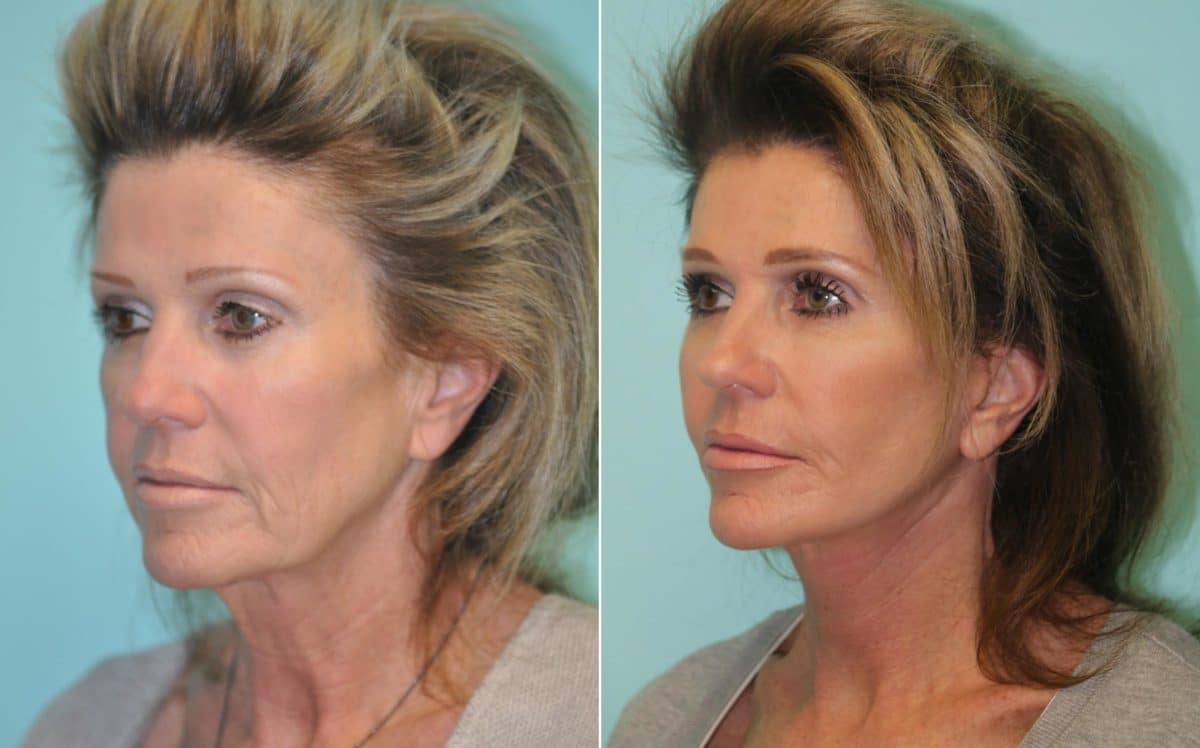 Before and after Facelift by Dr. Shervin Naderi, Patient 14162