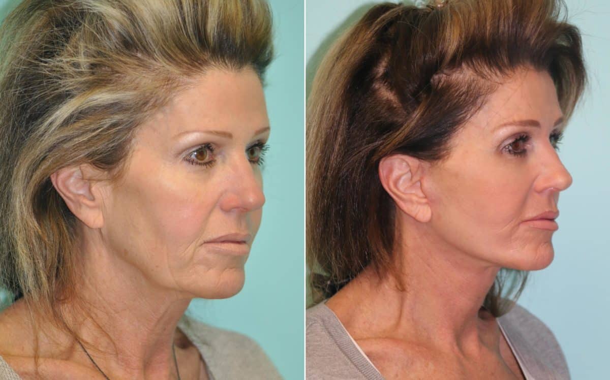 Before and after Facelift by Dr. Shervin Naderi, Patient 14162