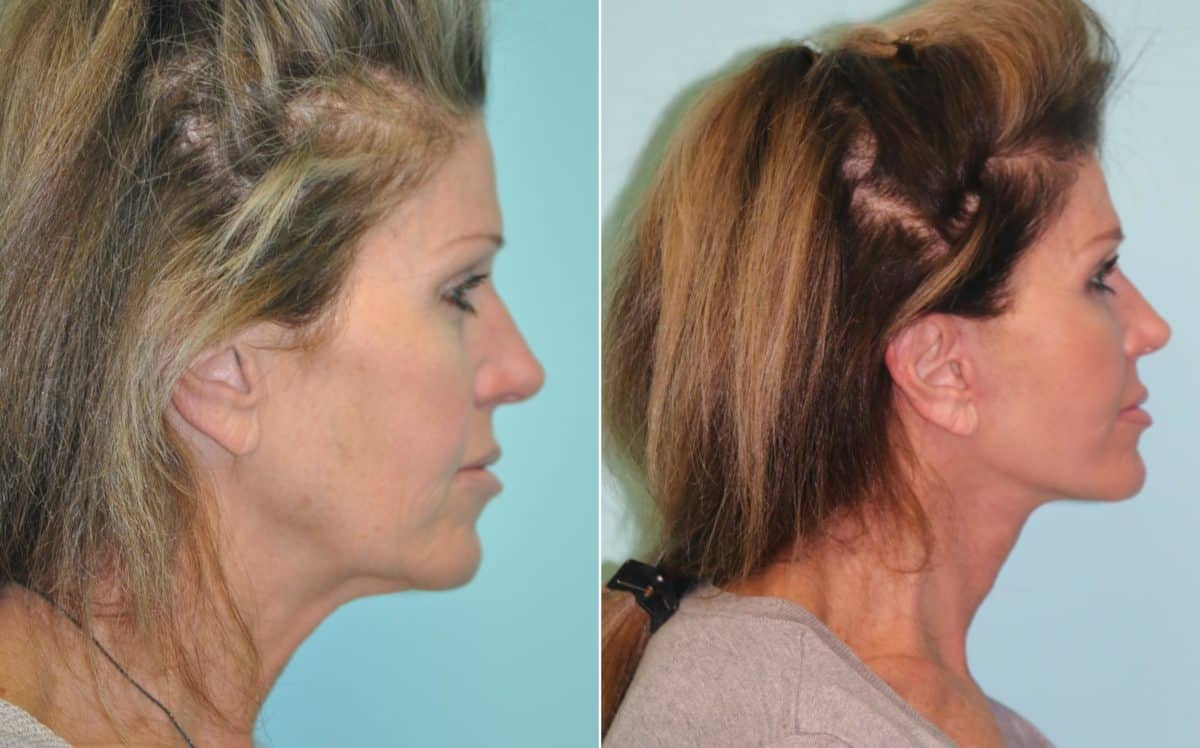 Before and after Facelift by Dr. Shervin Naderi, Patient 14162