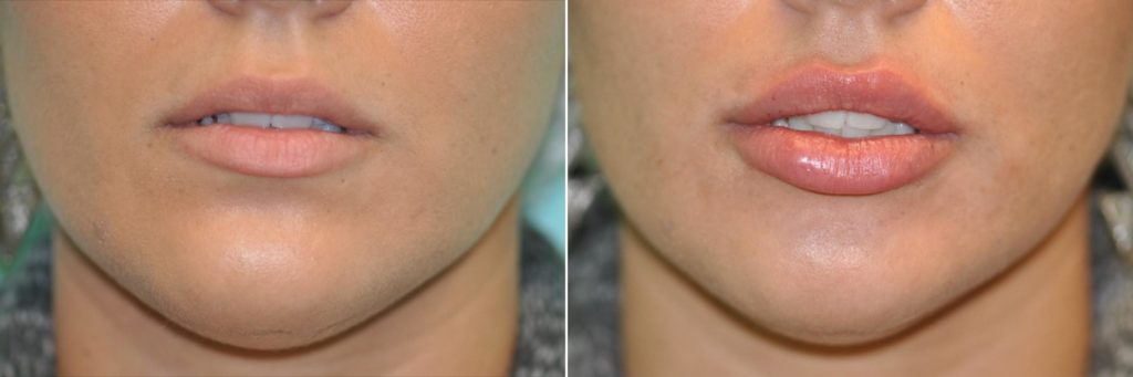 Lip augmentation with fuller lips and more defined cupid's bow, done by top plastic surgeons at The Naderi Center in Virginia and Maryland