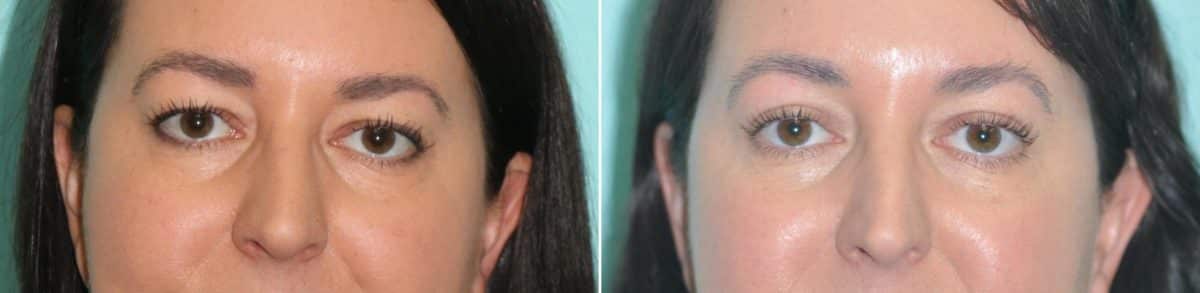 Before and after Blepharoplasty by Dr. Shervin Naderi, Patient 14206