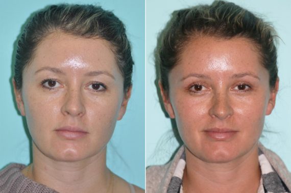 Before and after Blepharoplasty by Dr. Shervin Naderi, Patient 14278