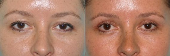 Before and after Blepharoplasty by Dr. Shervin Naderi, Patient 14278