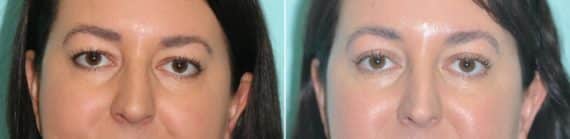 Before and after Blepharoplasty by Dr. Shervin Naderi, Patient 14206