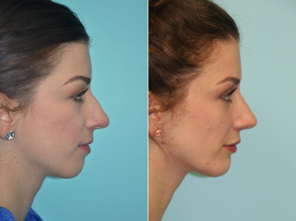 Before and After Chin Augmentation with Rhinoplasty. The Naderi Center | Virginia | Maryland