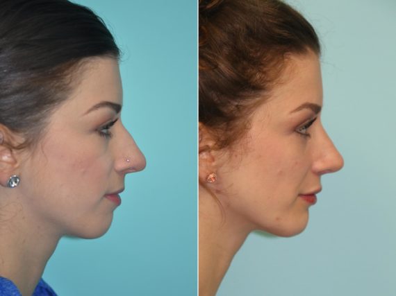 Before and after Chin & Facial Implant by Dr. Shervin Naderi, Patient 14210