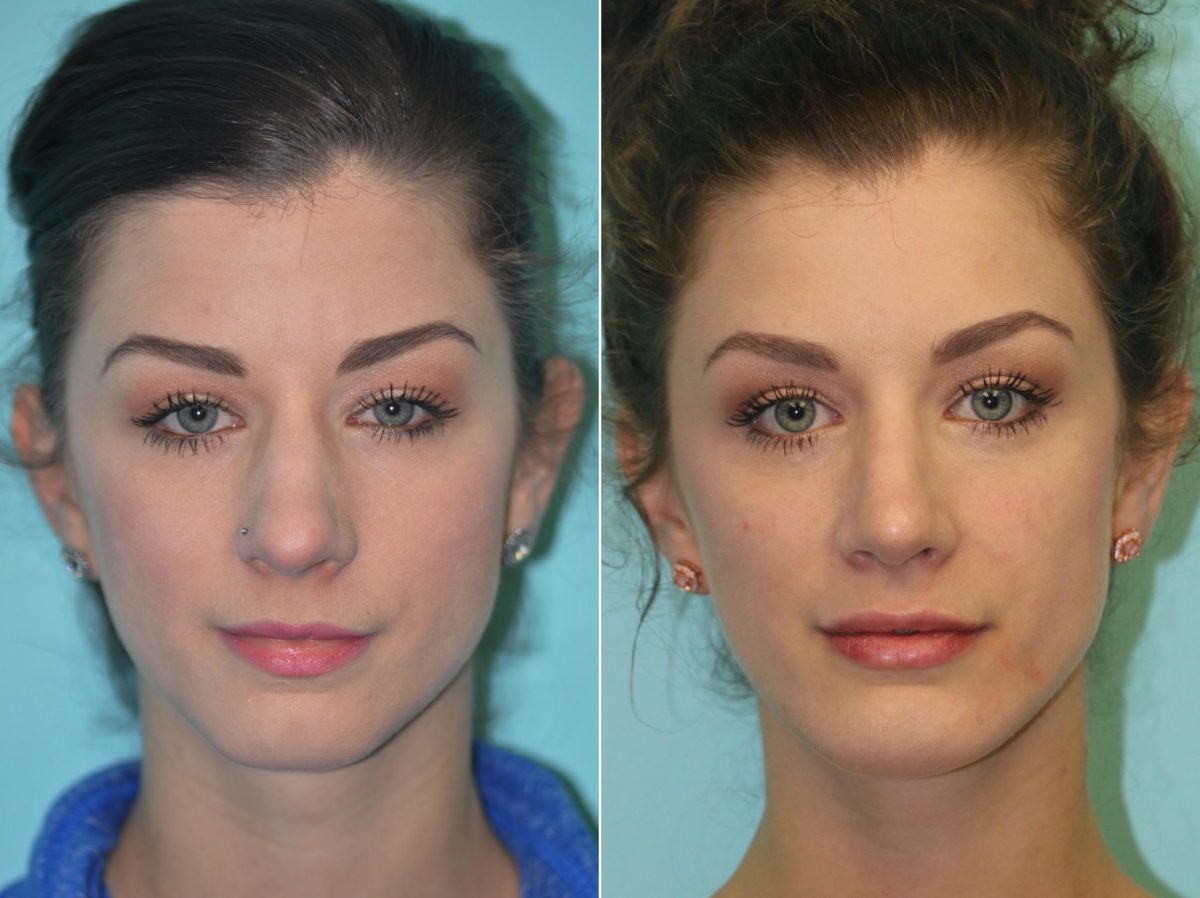 Before and after Chin & Facial Implant by Dr. Shervin Naderi, Patient 14210