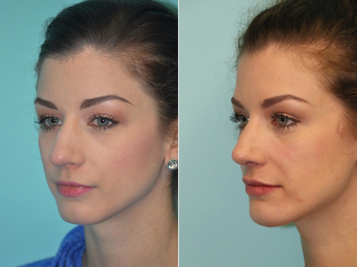 Before and after Chin & Facial Implant by Dr. Shervin Naderi, Patient 14210