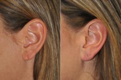 Before and after Ear Lobe Repair by Dr. Shervin Naderi, Patient 14325