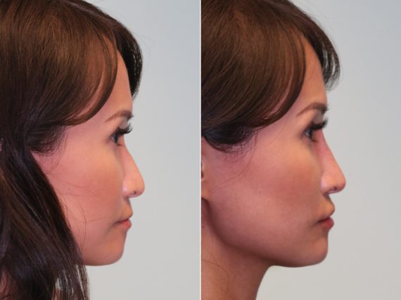 Before and after Non-Surgical Rhinoplasty by Dr. Shervin Naderi, Patient 14422