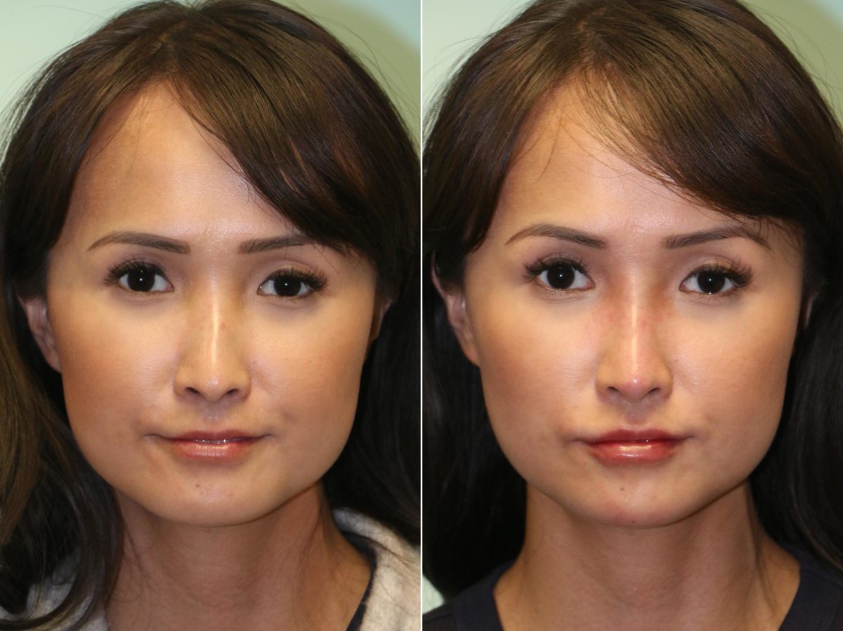 Before and after Non-Surgical Rhinoplasty by Dr. Shervin Naderi, Patient 14422