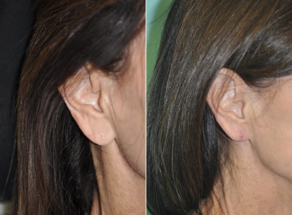 Before and after Ear Lobe Repair by Dr. Shervin Naderi, Patient 11961