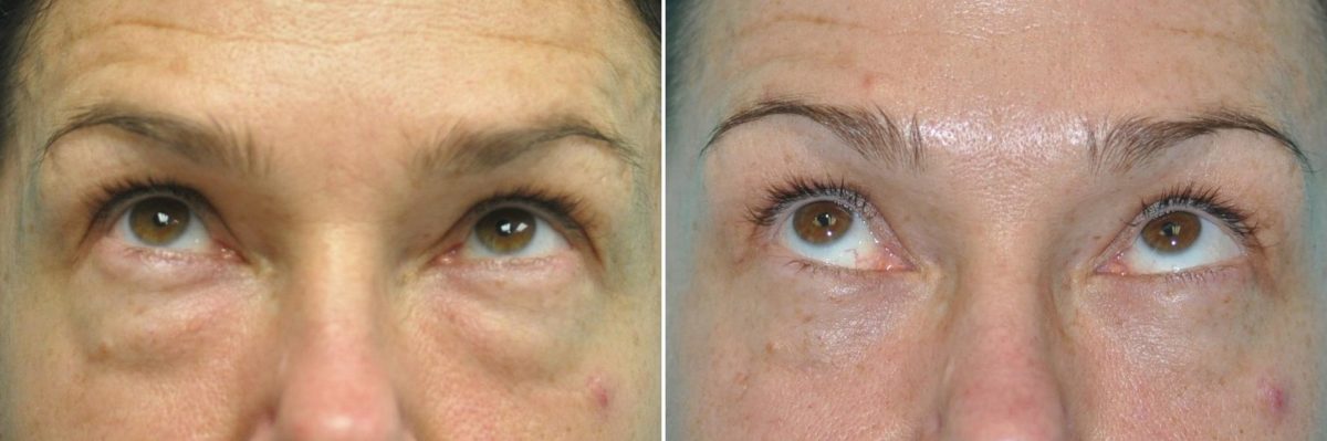 Before and after Blepharoplasty by Dr. Shervin Naderi, Patient 14268