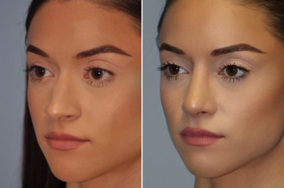 Before and after Rhinoplasty by Dr. Shervin Naderi, Patient 14285