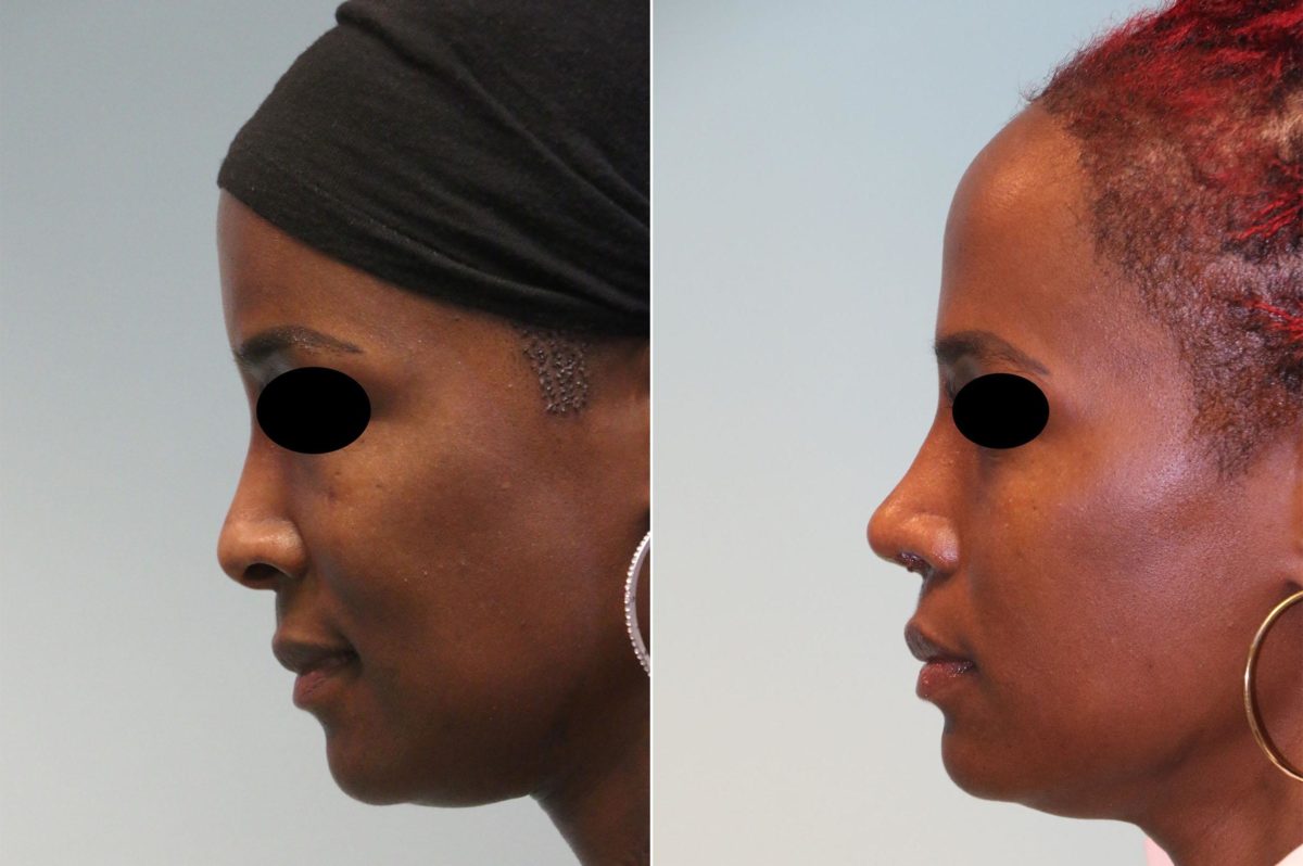 Before and after Rhinoplasty by Dr. Shervin Naderi, Patient 14408