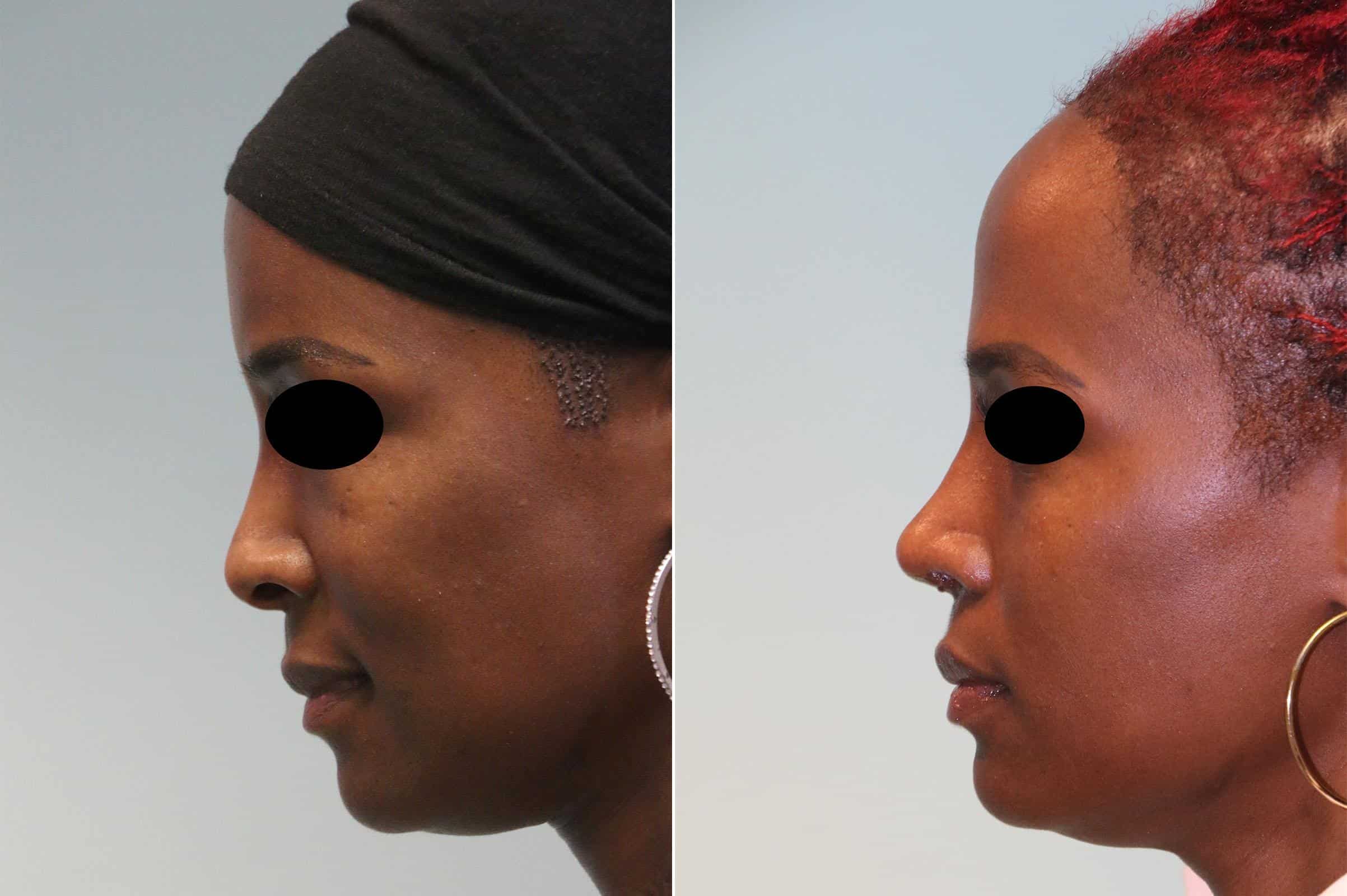 rhinoplasty-before-after