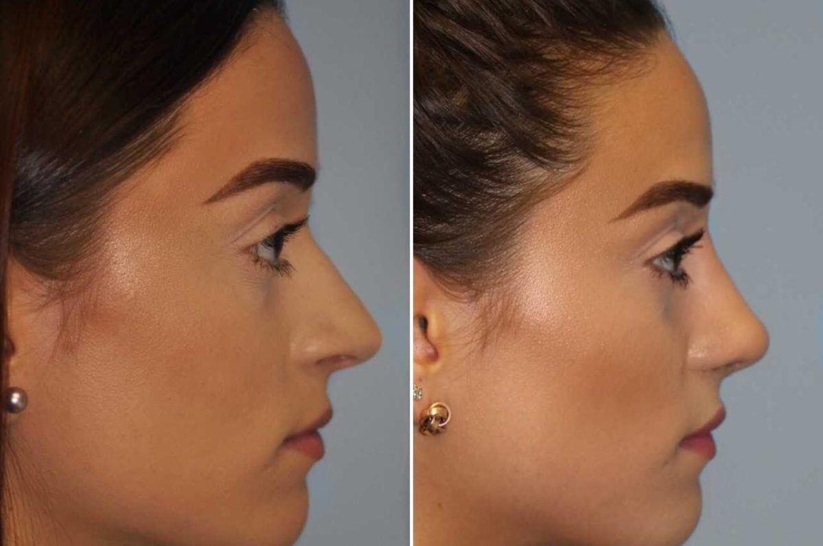 Before and after Rhinoplasty by Dr. Shervin Naderi, Patient 14285