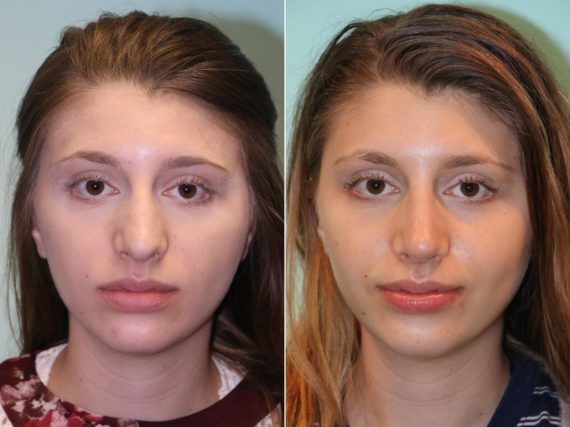 Before and after Rhinoplasty by Dr. Shervin Naderi, Patient 14295