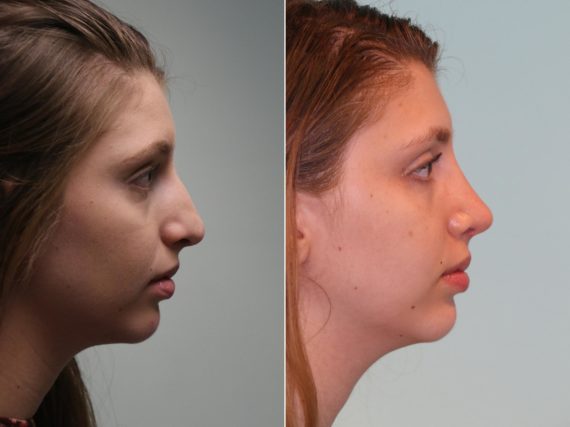 Before and after Rhinoplasty by Dr. Shervin Naderi, Patient 14295