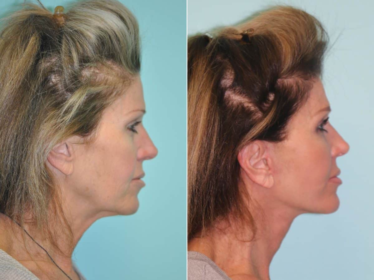 Before and after Skin Resurfacing by Dr. Shervin Naderi, Patient 14227