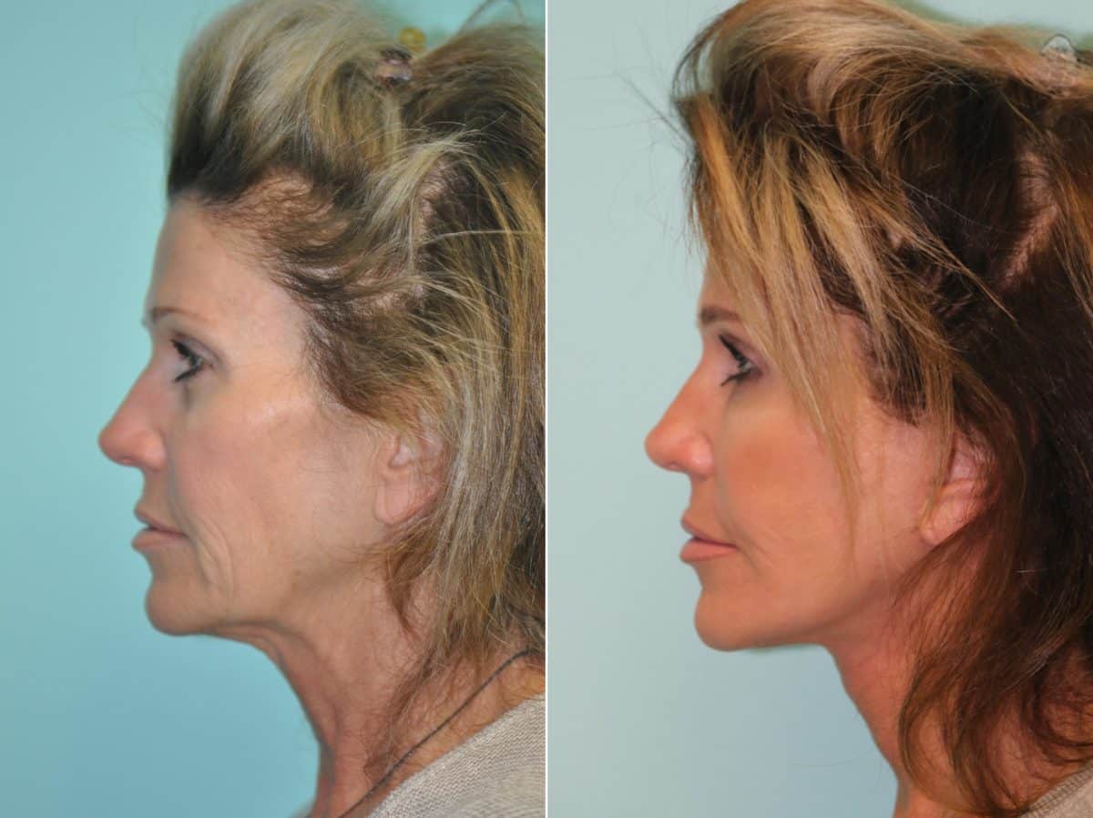 Before and after Skin Resurfacing by Dr. Shervin Naderi, Patient 14227