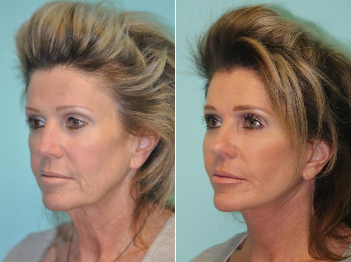 Before and after Skin Resurfacing by Dr. Shervin Naderi, Patient 14227