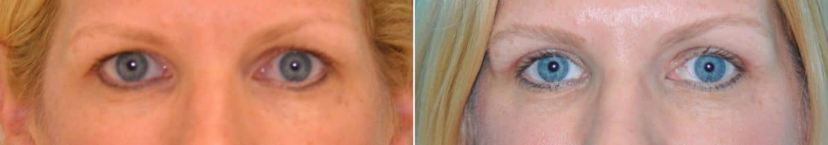 Before and after Blepharoplasty by Dr. Shervin Naderi, Patient 14609