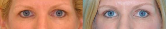 Before and after Blepharoplasty by Dr. Shervin Naderi, Patient 14609