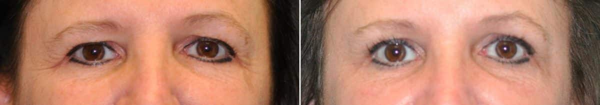 Before and after Blepharoplasty by Dr. Shervin Naderi, Patient 14589