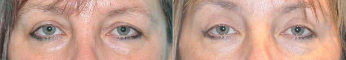 Before and after Blepharoplasty by Dr. Shervin Naderi, Patient 14644