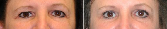 Before and after Blepharoplasty by Dr. Shervin Naderi, Patient 14589