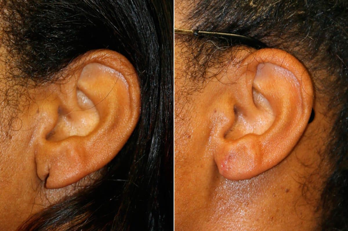 Before and after Ear Lobe Repair by Dr. Shervin Naderi, Patient 14583